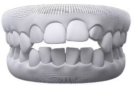 Open Bite