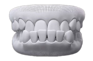 Underbite