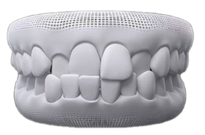 Cross Bite