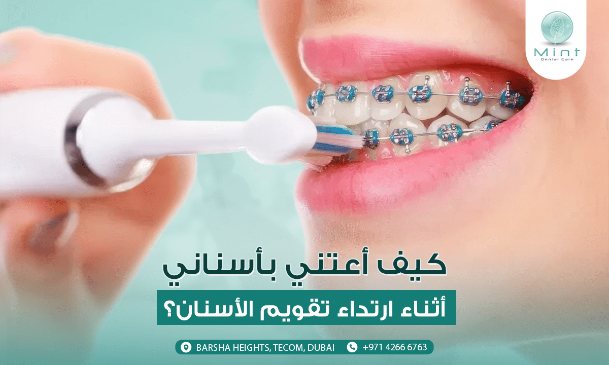 كيف أعتني بأسناني أثناء ارتداء تقويم الأسنان؟