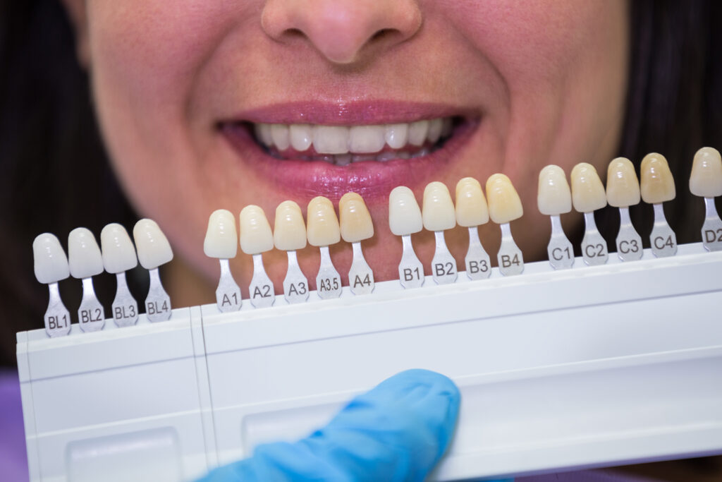 Composite Bonding