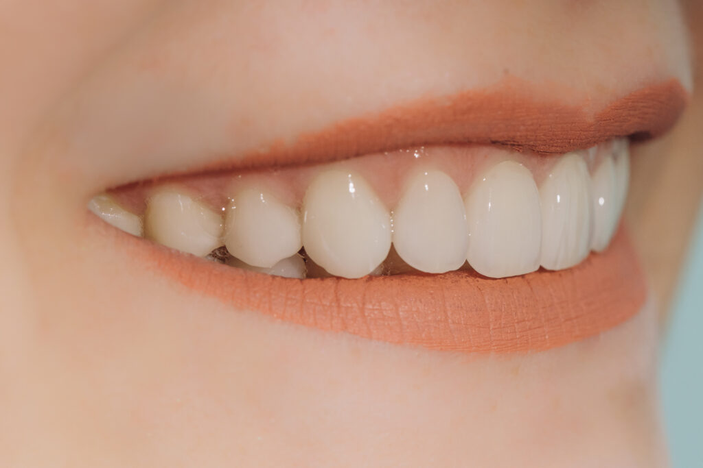 Teeth Whitening