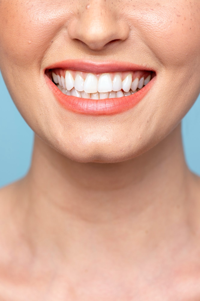 Hollywood Smile
