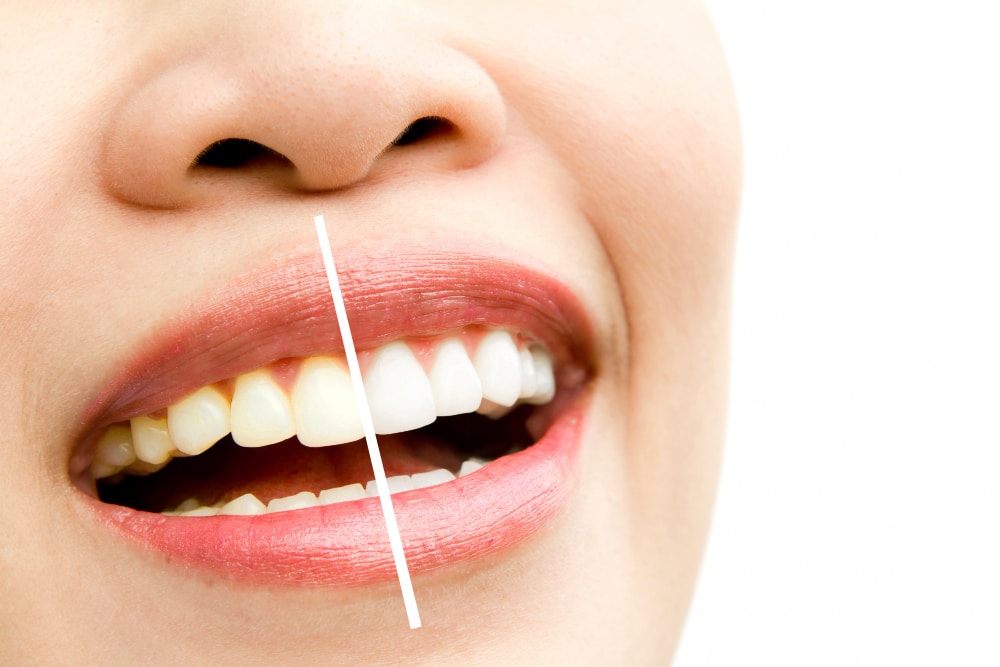Zoom Teeth Whitening