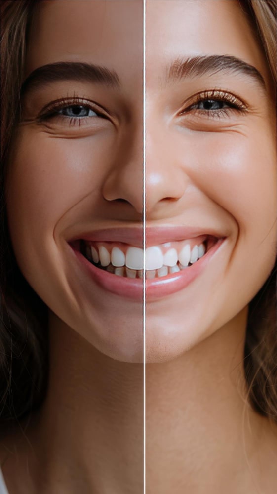 Teeth Whitening