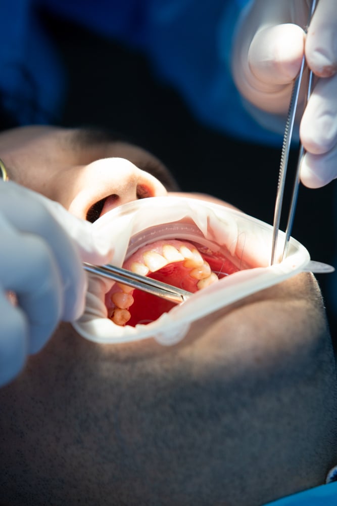 Root Canal Treatment